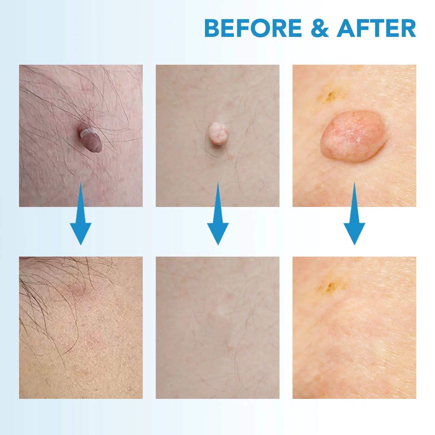 DermaBlu - Kit de Eliminación de Verrugas en Casa