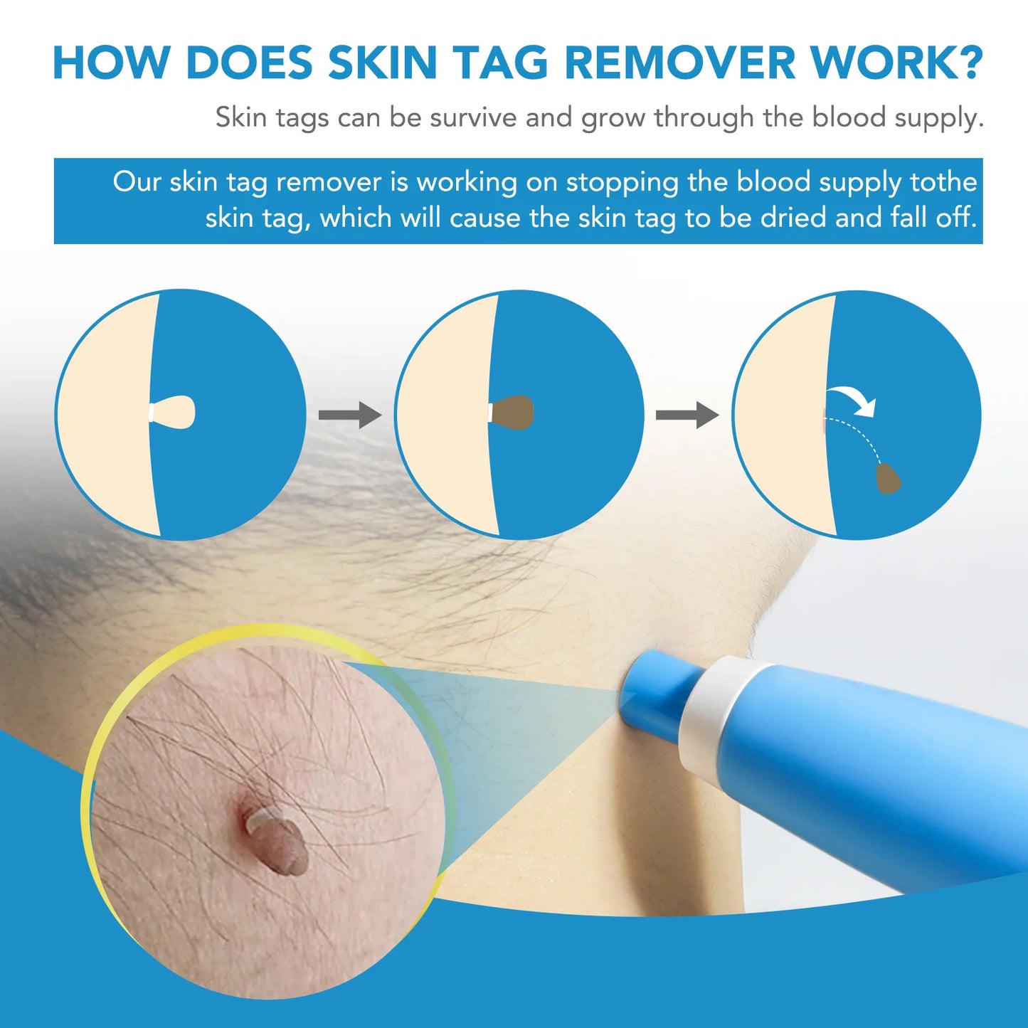 DermaBlu - Kit de Eliminación de Verrugas en Casa